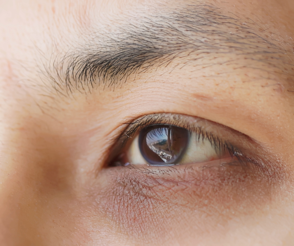 se débarrasser des cernes