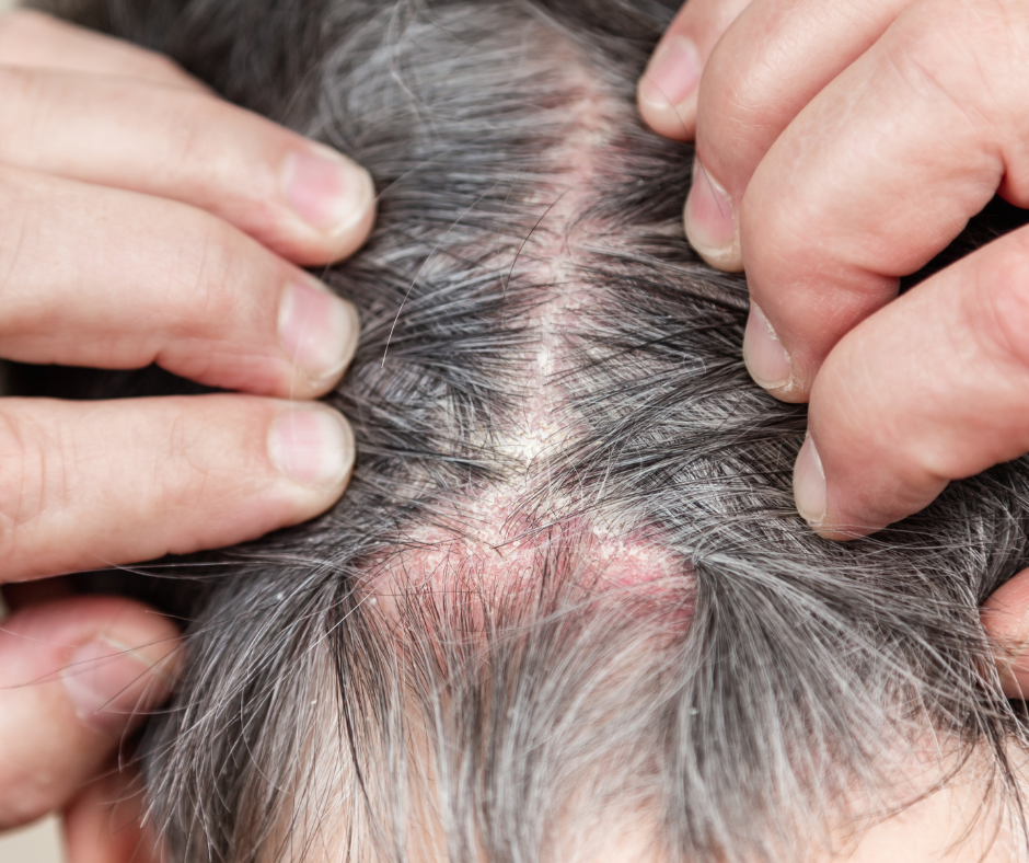 psoriasis des cheveux